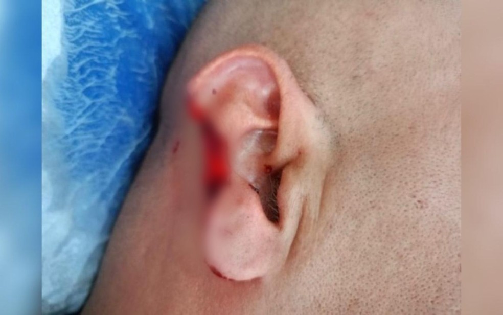 Homem arranca parte da orelha de policial durante abordagem - Gois  Foto: Reproduo/Polcia Militar