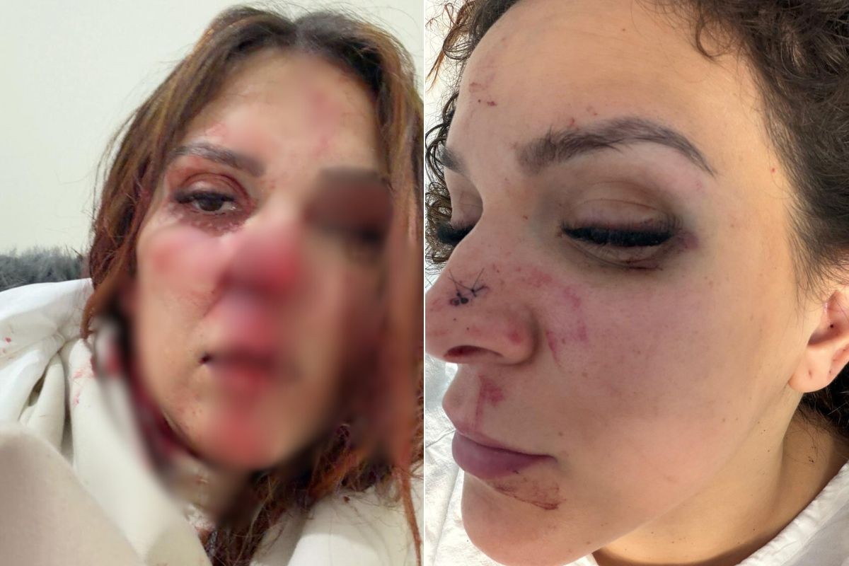 Brasileira que vive em Portugal diz ter sido espancada por marido que fugiu para o Brasil; VÍDEO