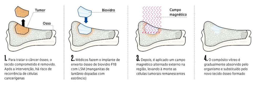 Material desenvolvido na UFSCar pode ajudar na reconstrução de ossos afetados pelo câncer — Foto: Arte Revista Pesquisa Fapesp
