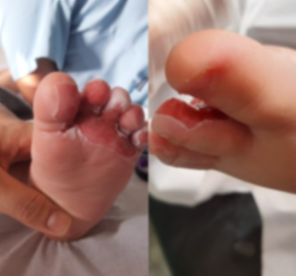 Bebê teve queimaduras no pé enquanto recebia um banho em uma creche de Criciúma — Foto: Arquivo pessoal