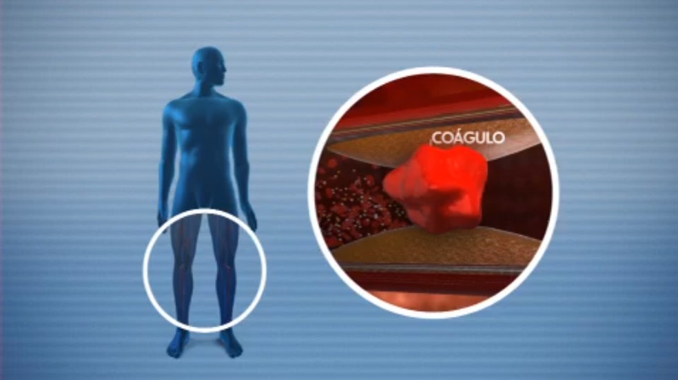 Coágulo que causa trombose  — Foto: Reprodução/TV Globo