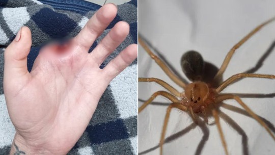 Homem picado por aranha venenosa tem dedo amputado e vive a síndrome do membro fantasma: 'sinto coçar'