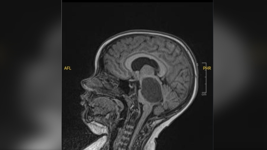Novo teste pode identificar tipo de tumor cerebral em menos de 2 horas e acelerar