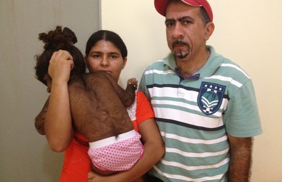 Kemilly Vitória nasceu com o corpo coberto de pelos e pais buscam tratamento — Foto: Fernanda Borges/G1