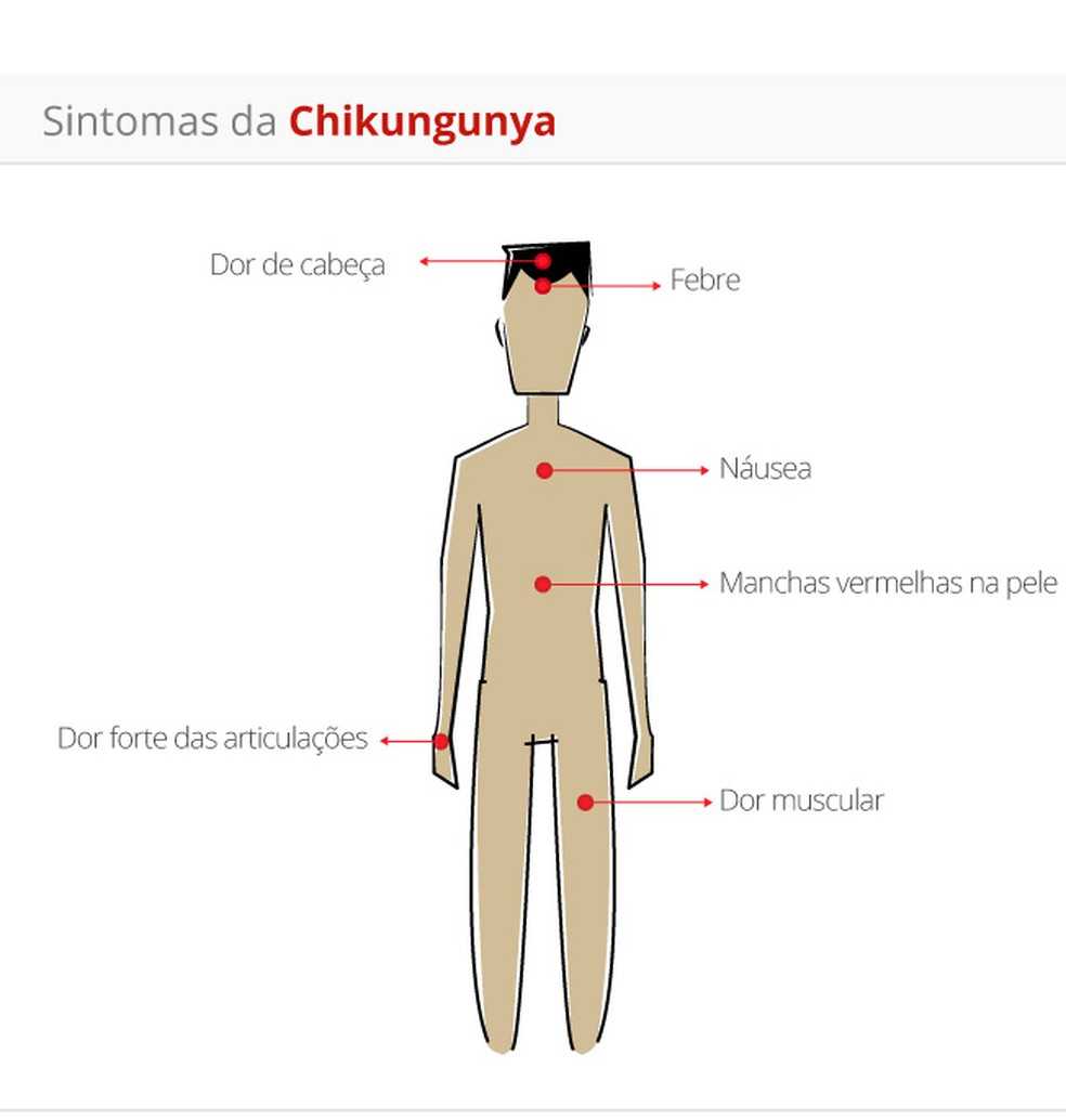 Chikungunya sintomas — Foto: Arte/G1