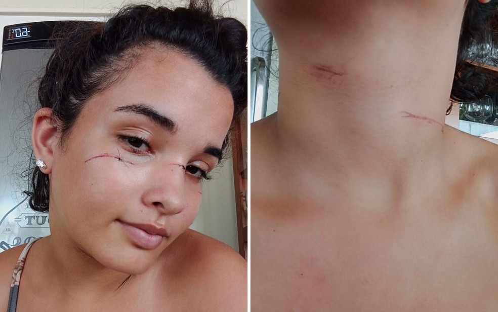 Adolescente tem pescoço e rosto cortados após ser atingida por linha enquanto andava com a mãe em moto: ‘Fiquei desesperada’