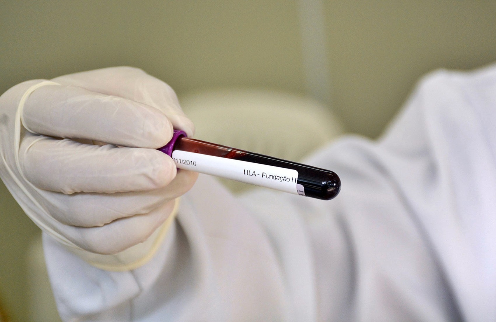 Unifal e Hospital do Amor fazem cadastramento de doadores de medula óssea em Alfenas nesta sexta-feira