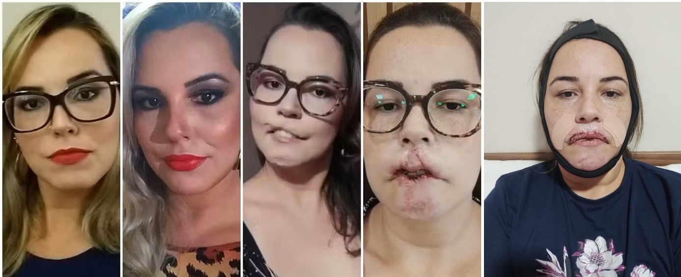 Influencer que perdeu lábio por uso de PMMA passa por 5ª e possivelmente última cirurgia em SC: 'Terei meu sorriso de volta'